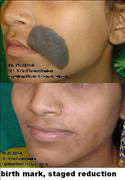 Before After Pictures, Cosmetic surgery, Delhi, birthmark removal
